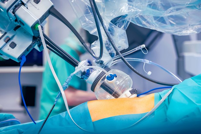 Roboter-assistierte Operationen Nahaufnahme eines Roboter-Operationssystems, das Instrumente über einen klaren Trokar in den Bauch eines Patienten einführt.
